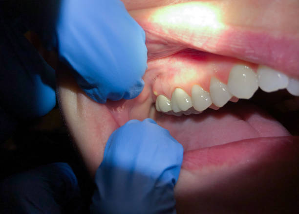 Best Emergency Root Canal Treatment in Bellefonte, PA